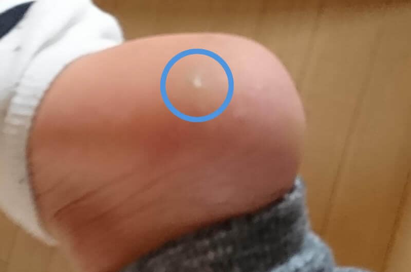 痛い魚の目の原因と自分でできる治療法。皮膚科での手術までのまとめ! 痛い魚の目
