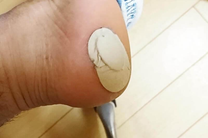 痛い魚の目の原因と自分でできる治療法。皮膚科での手術までのまとめ! 痛い魚の目の原因と自分でできる治療法。皮膚科での手術までのまとめ!