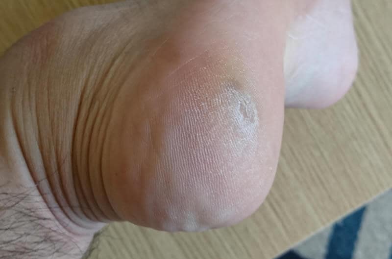 痛い魚の目の原因と自分でできる治療法。皮膚科での手術までのまとめ! 取り除けなかった魚の目