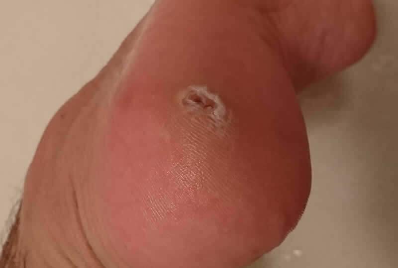 痛い魚の目の原因と自分でできる治療法。皮膚科での手術までのまとめ! 皮膚科で魚の目除去